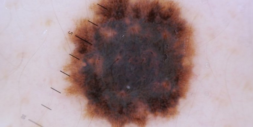 mole treatment Orange CA