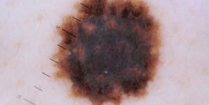 Shouldn’t You Know About Dermal Fillers and Skin Cancer Treatment Options?