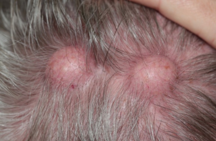 Should You Visit a Specialist for Cyst and Wrinkle Treatments in Long Beach?